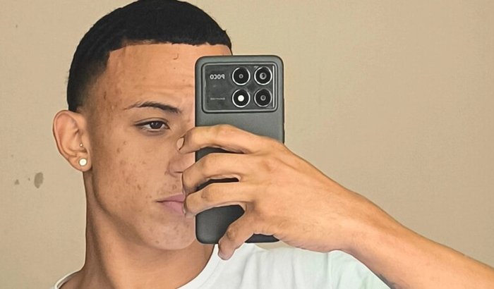 Minha cirurgia de ceratocone