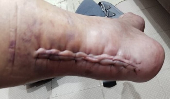 Cirurgia para substituição de tendão de Aquiles rompido