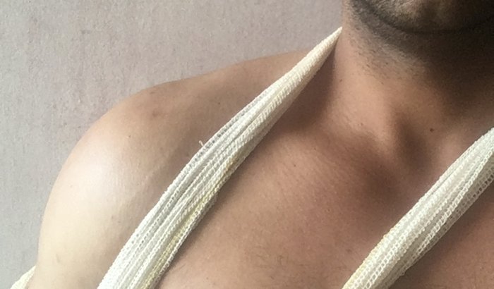 CIRURGIA DO OMBRO COM DUPLA FRATURA