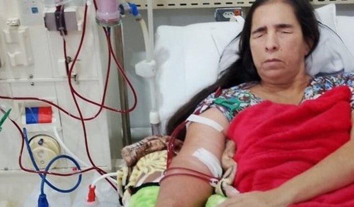 Fístula da hemodiálise 