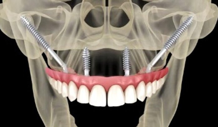 IMPLANTE ZIGOMÁTICO