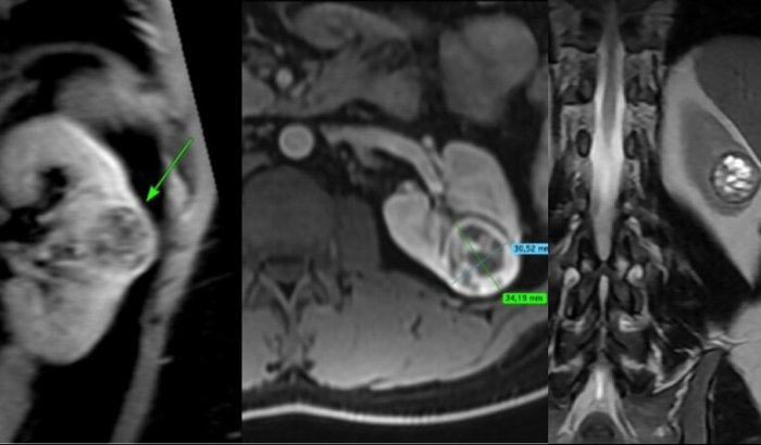 Ajuda para custear os honorários médicos na Cirurgia para retirada de Câncer Renal