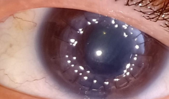 Despesas com meu segundo Transplante de Córnea