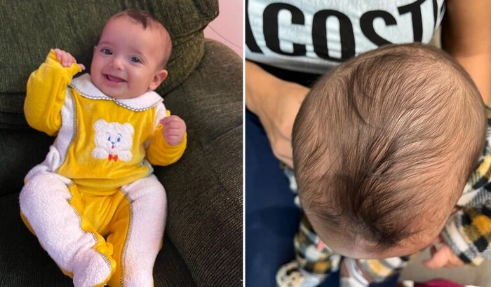 Tratamento Hendric - Órtese Craniana