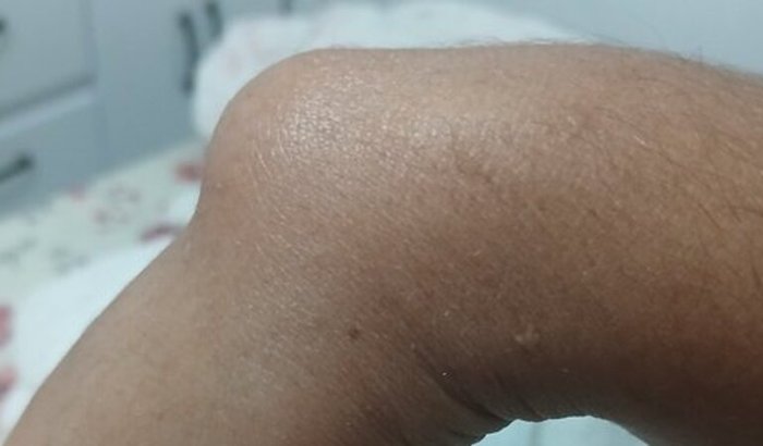 Ajuda para fazer cirurgia do cisto