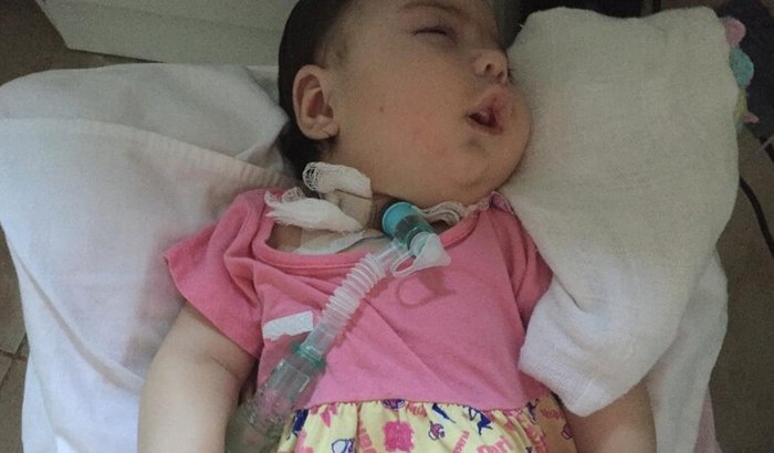 bebê de 2 anos acamada com paralisia cerebral severa