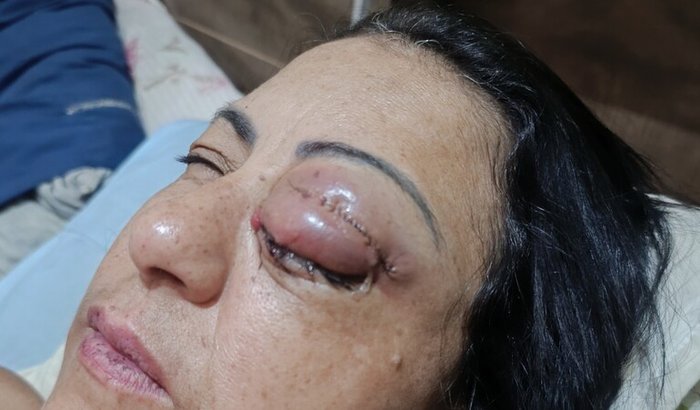 Em prol de uma Cirurgia de orbita (de urgência)