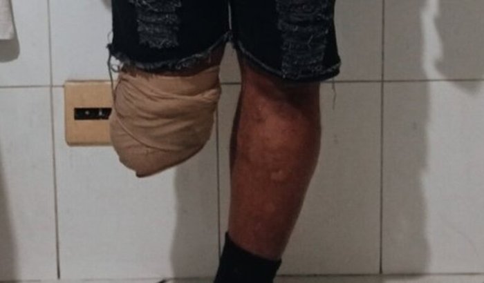 Prótese para o Wagner Ribeiro