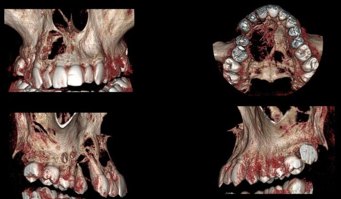 Ajuda para tratamento de câncer na boca