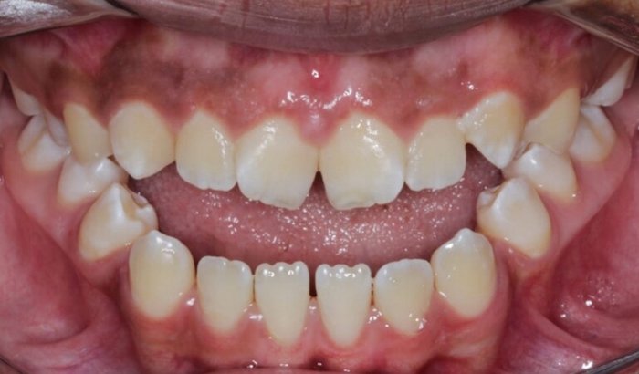 Ajude o Caio a conquistar qualidade de vida com uma cirurgia ortognática!