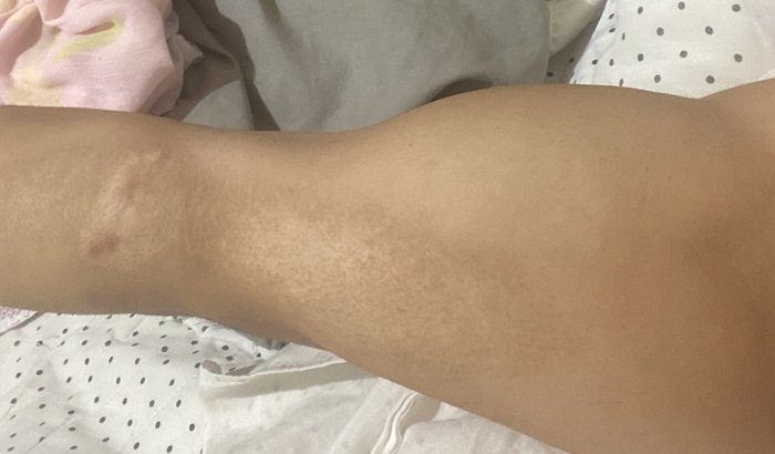 Ajuda para cirurgia de rompimento de bíceps