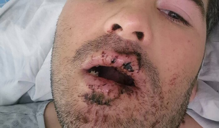 Implante de 9 dentes frontais ( Rodrigo Rocha )