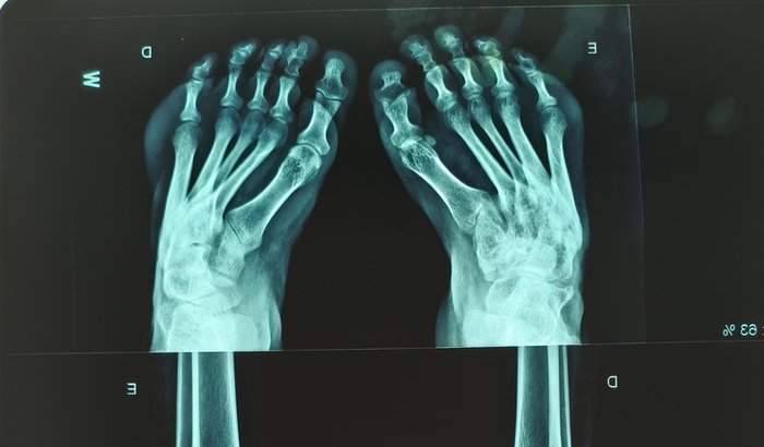 Minha cirurgia (pé torto congênito)