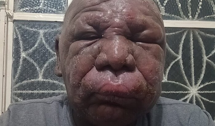 Campanha pelo tratamento de Nilson contra o câncer.