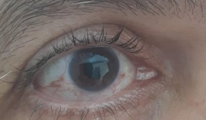 Cirurgia de glaucoma, quero voltar a enxergar!