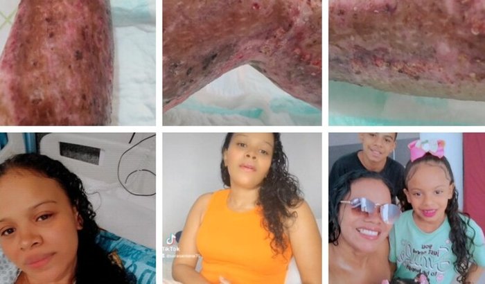 Câmara Hiperbárica para tratamento de queimadura