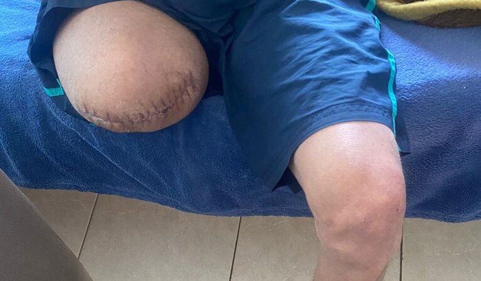 Prótese Transfemoral direita