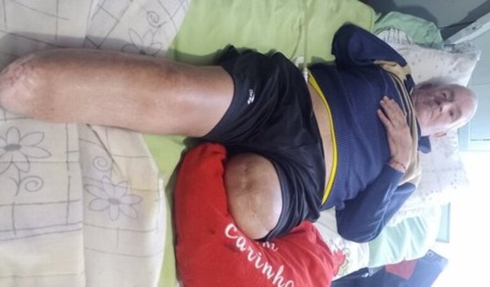 Miguel Ledur. Ajude na Aquisição da Prótese!!