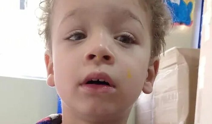 Óculos do Alexs ( cicatriz na retina, sequelas da toxoplasmose)