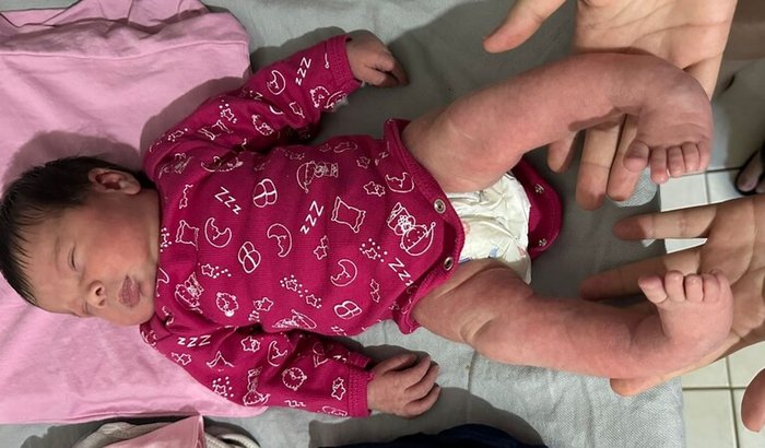 Heloíse, 8 dias de vida, pé torto congênito.