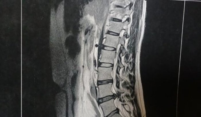 Cirurgia de hérnia de disco