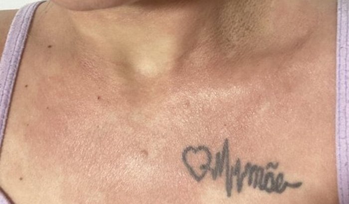 Tratamento de pele (Dermatite Atópica)