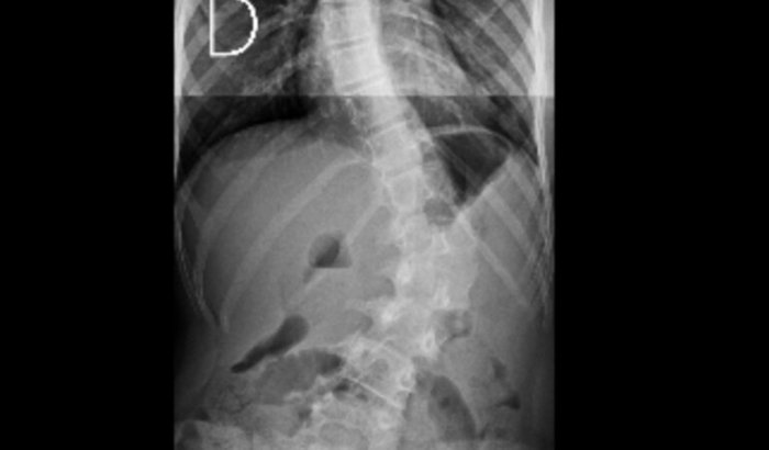 Tratamento para escoliose da Helô