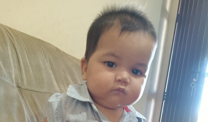 Assimetria craniana / torcicolo congênito da Rafaela