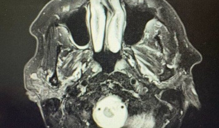 Saúde Ressonância Gama Knife