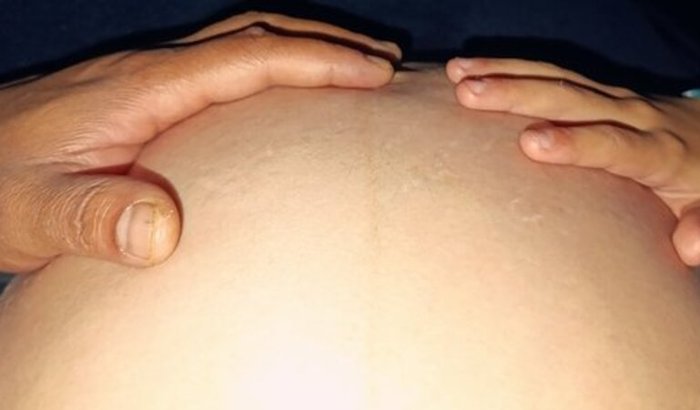 Injeções de enoxaparina 40mg para as gêminhas🩷🩷