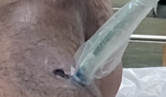 Ajuda médica contra Saaf e lúpus