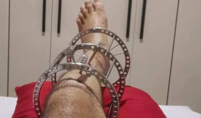 Fazer cirurgia da tíbia esquerda 