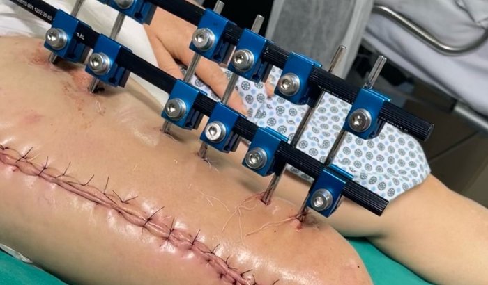 Cirurgia de osteomielite de Cleonice