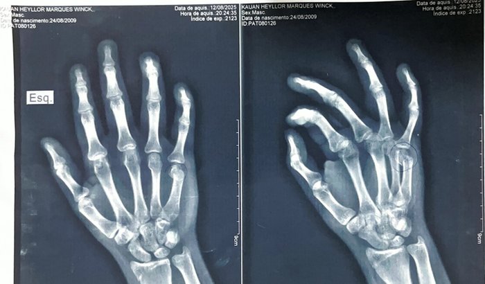 Cirurgia para a mão do Kauã