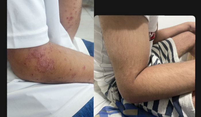 Tratamento Dermatite atópica severa