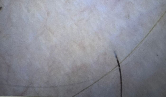 TRATAMENTO DE ALOPÉCIA AREATA.