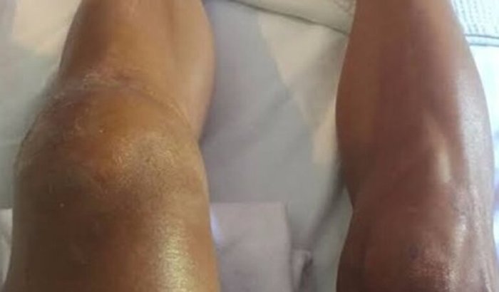 Cirurgiã do joelho direito