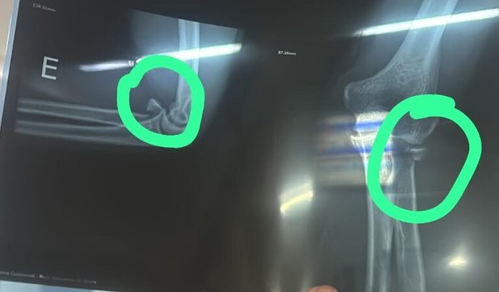 Recuperação Douglas