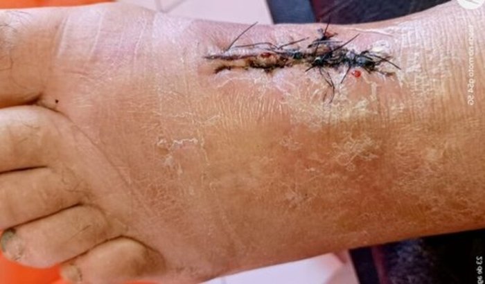 Tratamento Edmir Lopes Duhau/NENECO