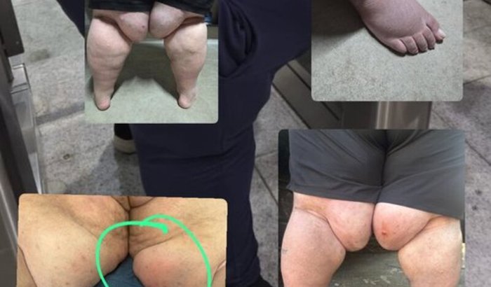 Ajude a Cirurgia Bariátrica do André