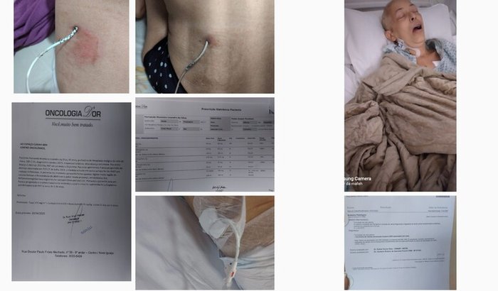 Tratamento de Câncer no Colo do útero