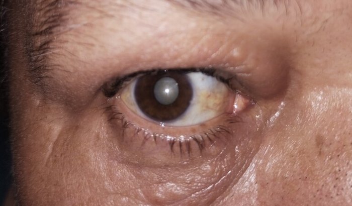 Cirurgia de catarata da Márcia