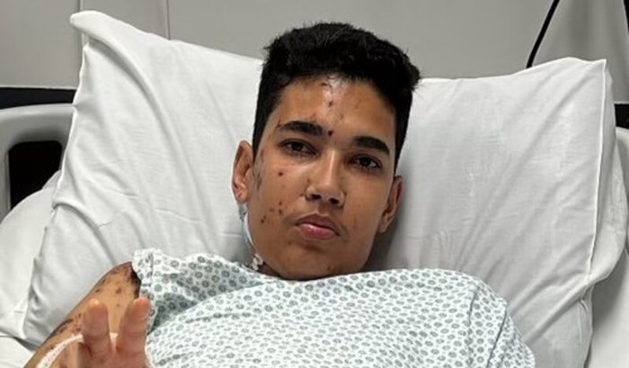 Um novo começo: Próteses para o Arthur