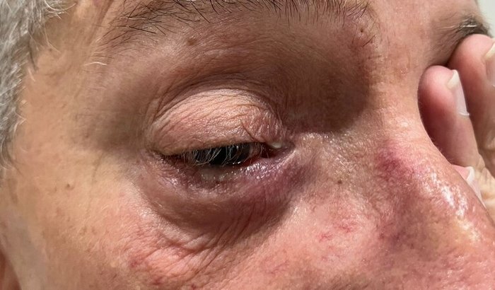 Vakinha do Eduardo - Cirurgia das Vias Lacrimais