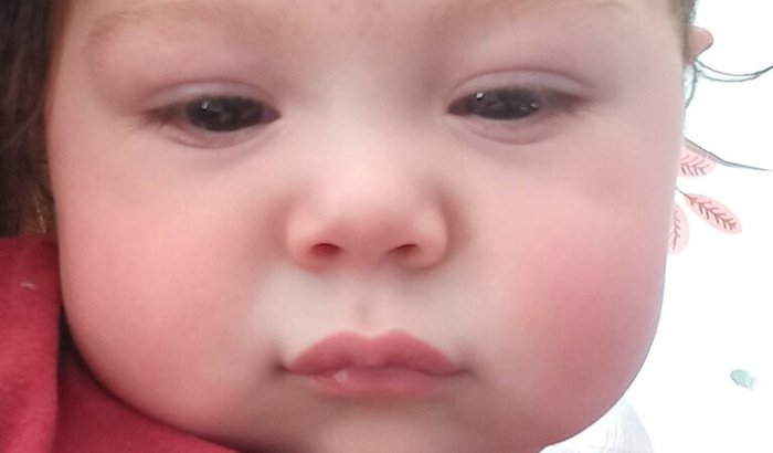 Cirurgia de Reconstrução do Plexo Braquial do Vicente