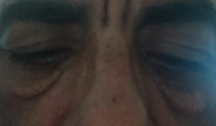 Cirurgia blefaroplastia