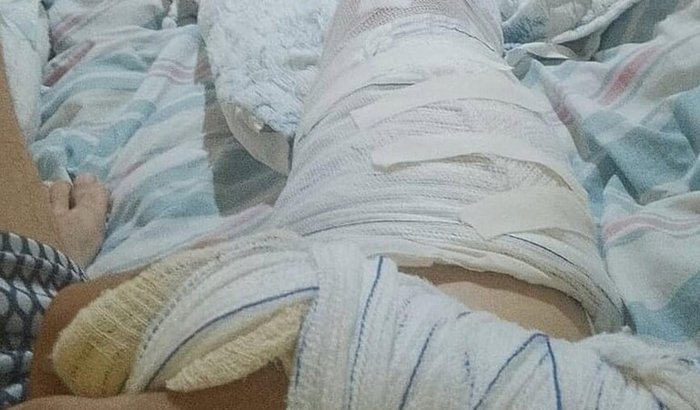 Ajude Andrey para tratamentos pós lesão de plexo braquial