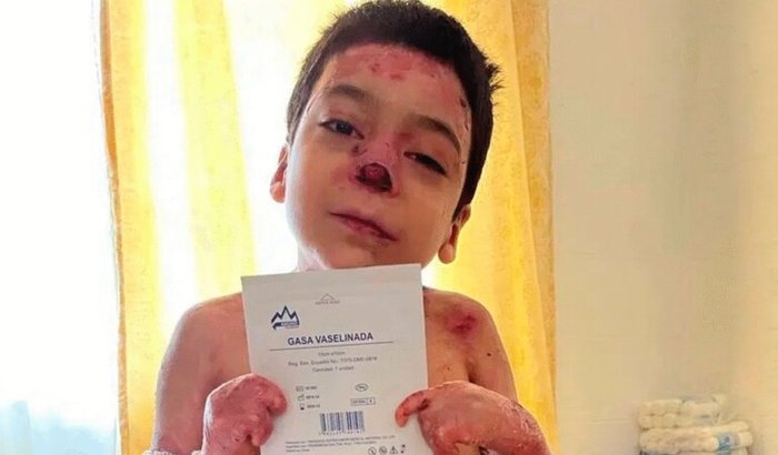 Ajude o Guilherme contra Epidermólise bolhosa
