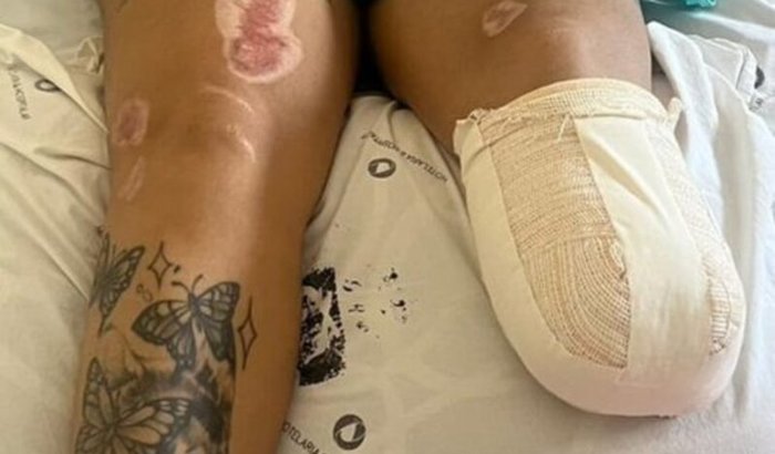 Um novo passo: me ajude a conquistar minha prótese e recomeçar 🙏 