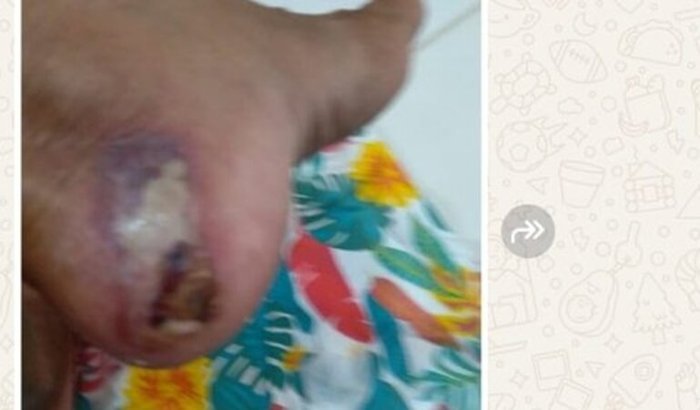 Tratamento pés Diabéticos  Jane Siva dos  Santos